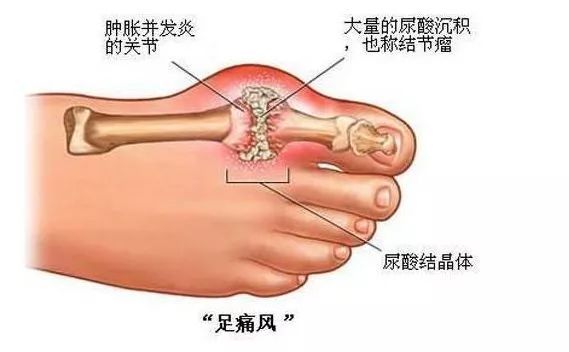 饭后血压 血糖多少合适?血糖与年龄对照表